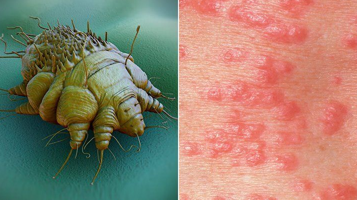 Scabies Nedir, Ne Anlama Gelir? Nasıl Tedavi Edilir? 2022 1 Scabies Nedir, Ne Anlama Gelir? Nasıl Tedavi Edilir? 2022
