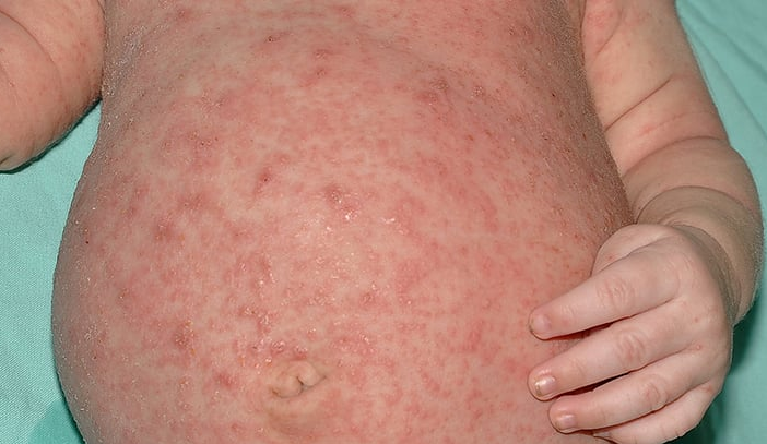 Scabies Nedir, Ne Anlama Gelir? Nasıl Tedavi Edilir? 2022 3 image 327